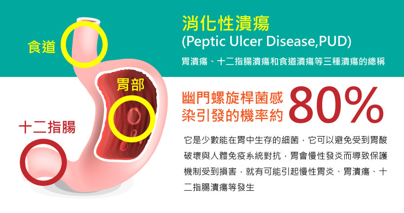 消化性潰瘍示意圖