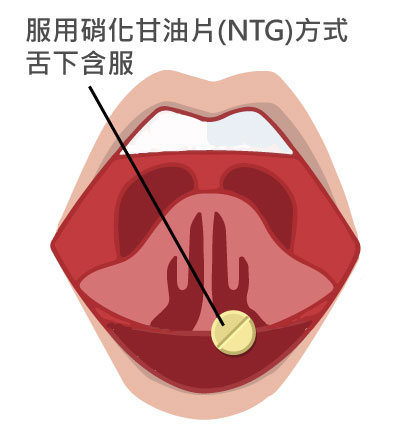 服用硝化甘油片(NTG)方式舌下含服示意圖